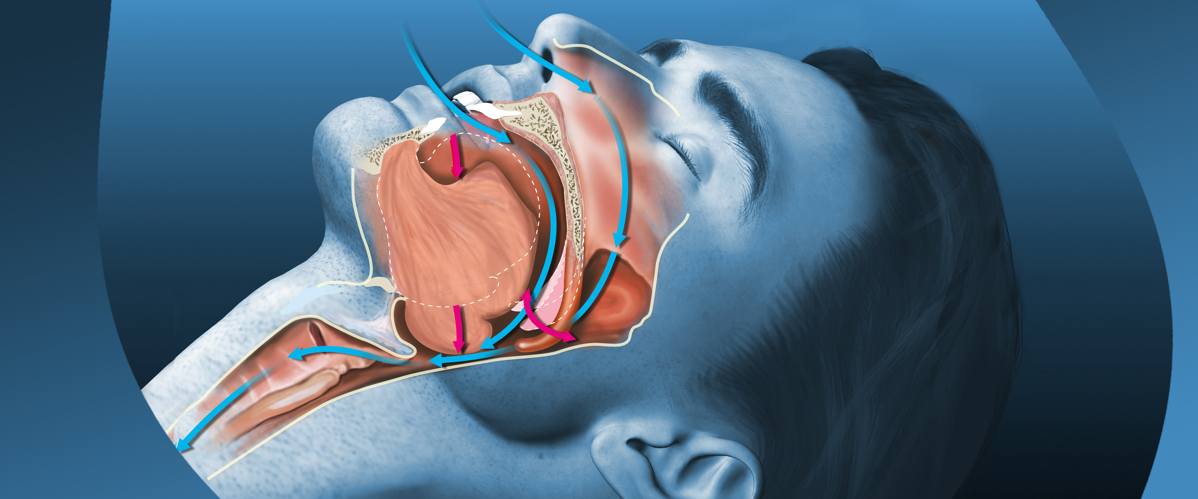Nasal Strips to Stop Snoring: An In-depth Analysis